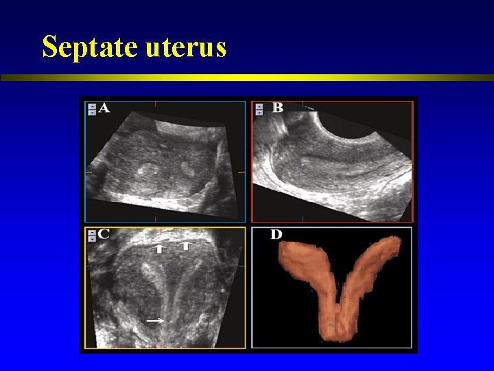 Septate uterus 