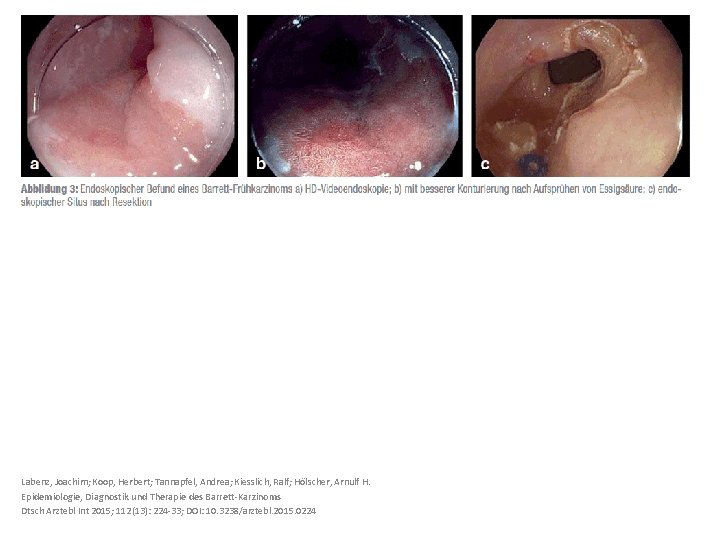 Labenz, Joachim; Koop, Herbert; Tannapfel, Andrea; Kiesslich, Ralf; Hölscher, Arnulf H. Epidemiologie, Diagnostik und