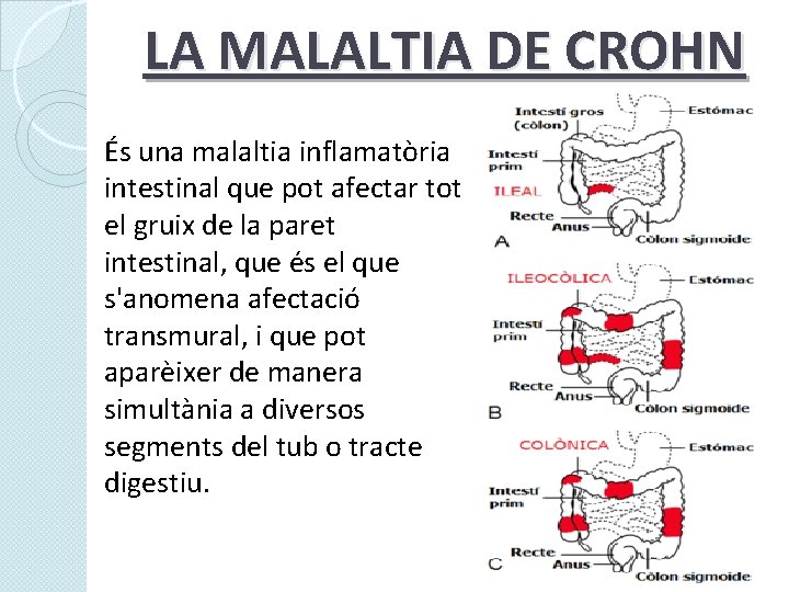 LA MALALTIA DE CROHN És una malaltia inflamatòria intestinal que pot afectar tot el