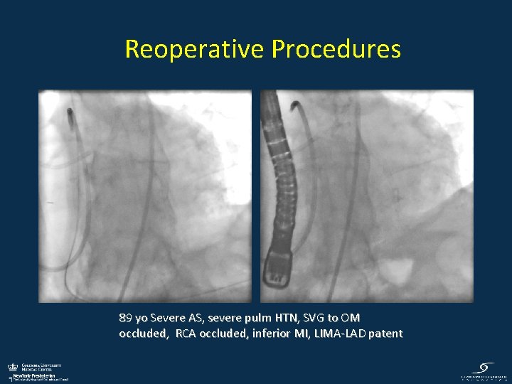 Reoperative Procedures 89 yo Severe AS, severe pulm HTN, SVG to OM occluded, RCA
