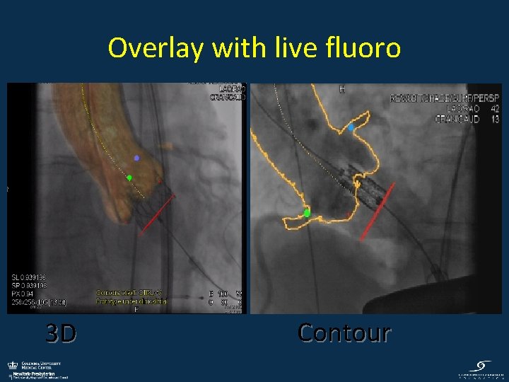 Overlay with live fluoro 3 D Contour 