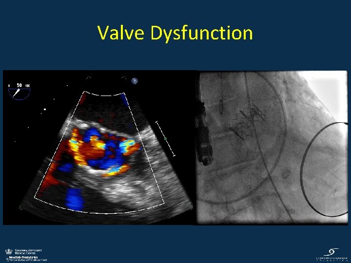 Valve Dysfunction 