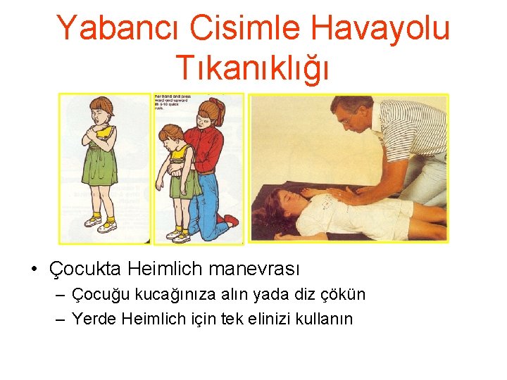 Yabancı Cisimle Havayolu Tıkanıklığı • Çocukta Heimlich manevrası – Çocuğu kucağınıza alın yada diz