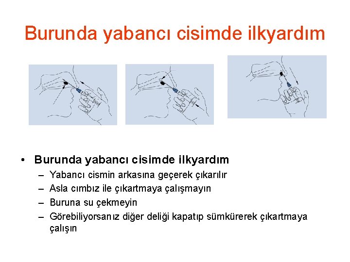 Burunda yabancı cisimde ilkyardım • Burunda yabancı cisimde ilkyardım – – Yabancı cismin arkasına