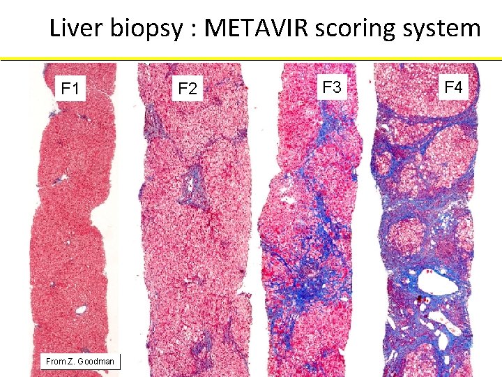Liver biopsy : METAVIR scoring system F 1 From Z. Goodman F 2 F