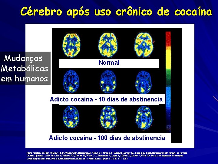 Cérebro após uso crônico de cocaína Mudanças Metabólicas em humanos Normal Adicto cocaina -