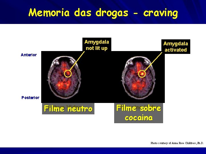 Memoria das drogas - craving Amygdala not lit up Amygdala activated Anterior Posterior Nature