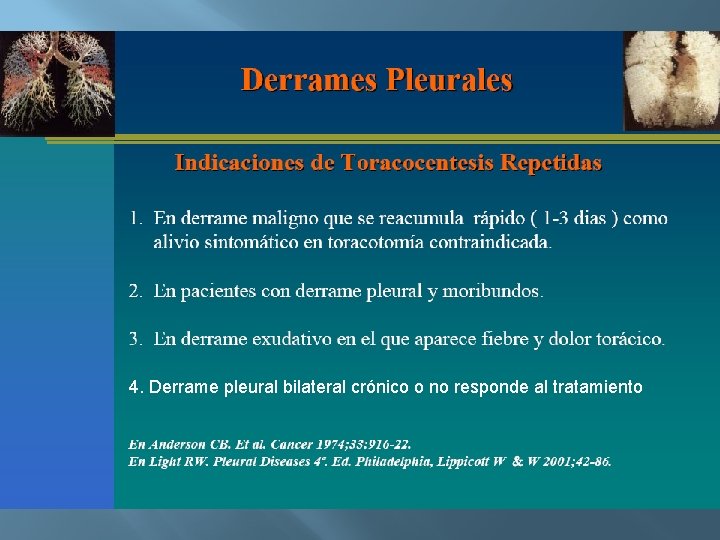 4. Derrame pleural bilateral crónico o no responde al tratamiento 