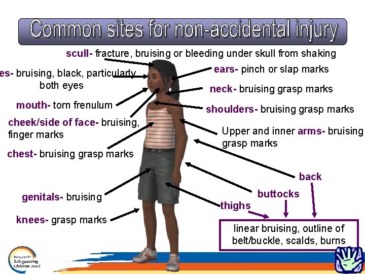 scull- fracture, bruising or bleeding under skull from shaking es- bruising, black, particularly both