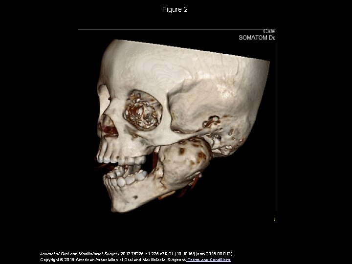 Figure 2 Journal of Oral and Maxillofacial Surgery 2017 75226. e 1 -226. e