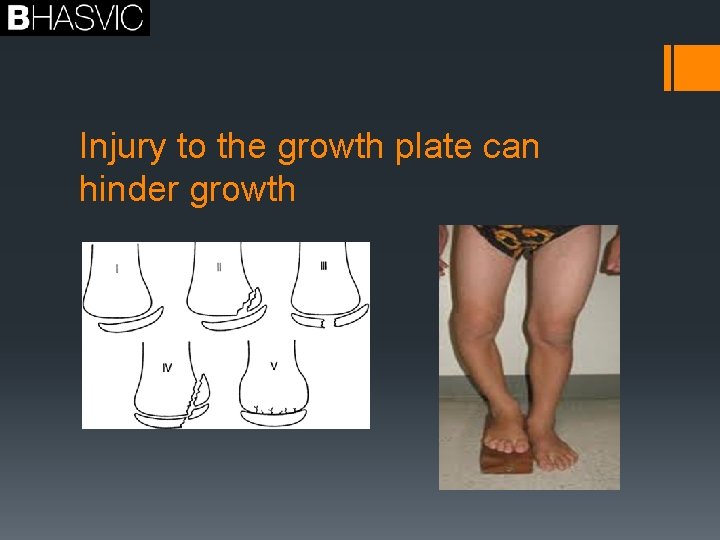 Injury to the growth plate can hinder growth 