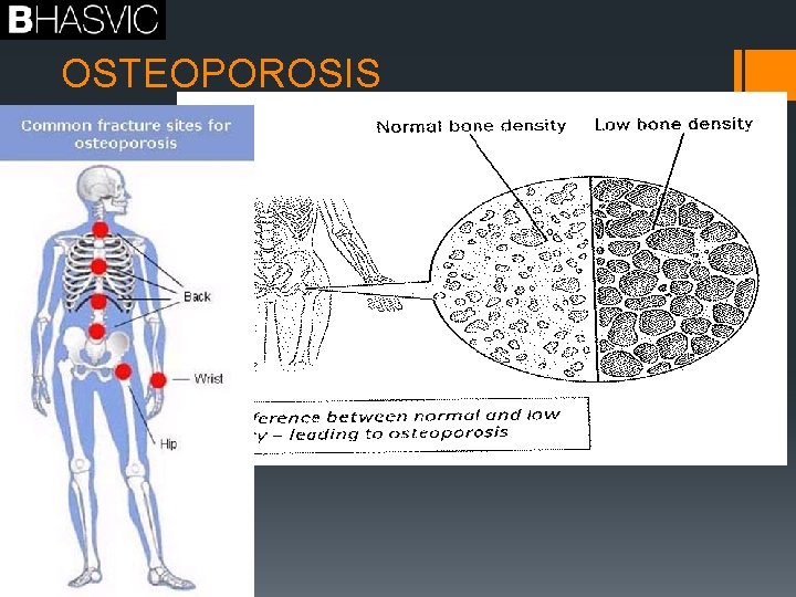 OSTEOPOROSIS 