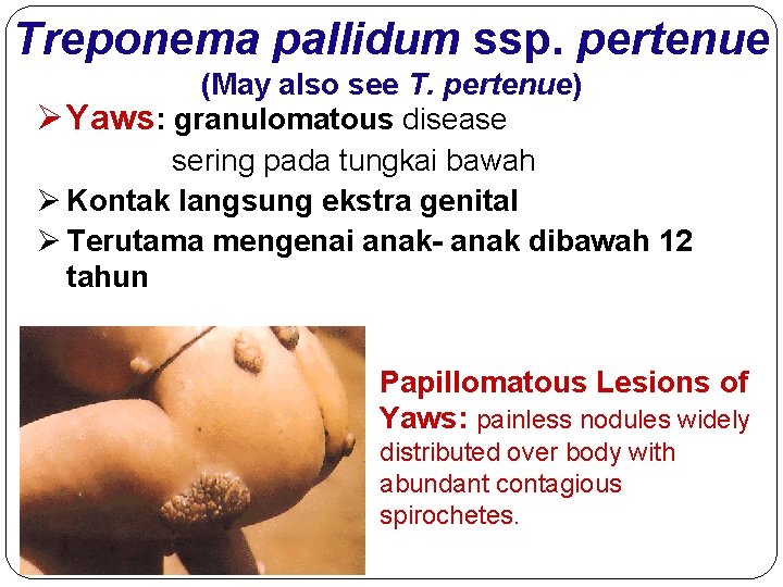 Treponema pallidum ssp. pertenue (May also see T. pertenue) Ø Yaws: granulomatous disease sering