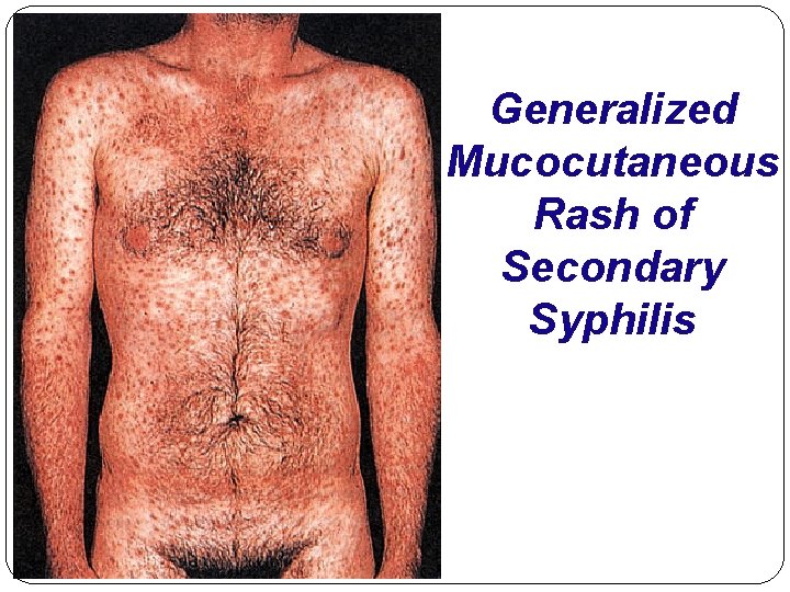 Generalized Mucocutaneous Rash of Secondary Syphilis 