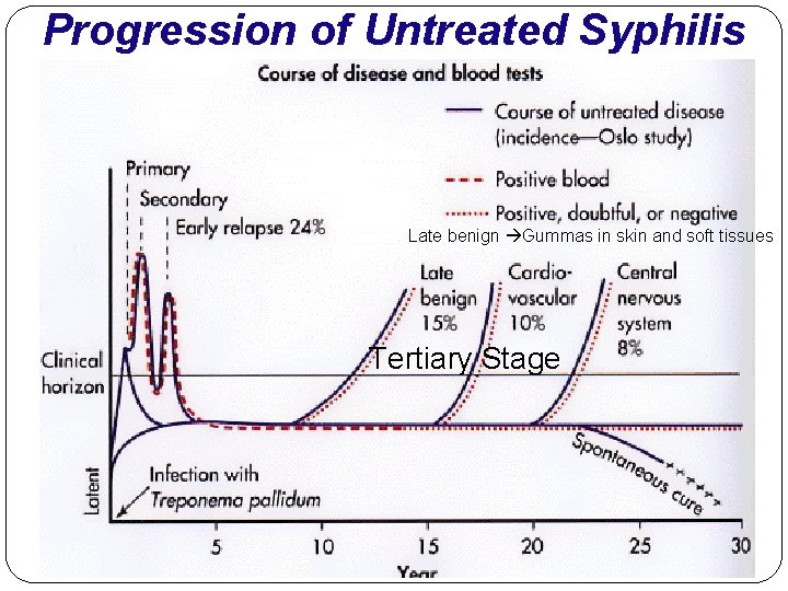 Progression of Untreated Syphilis Late benign Gummas in skin and soft tissues Tertiary Stage