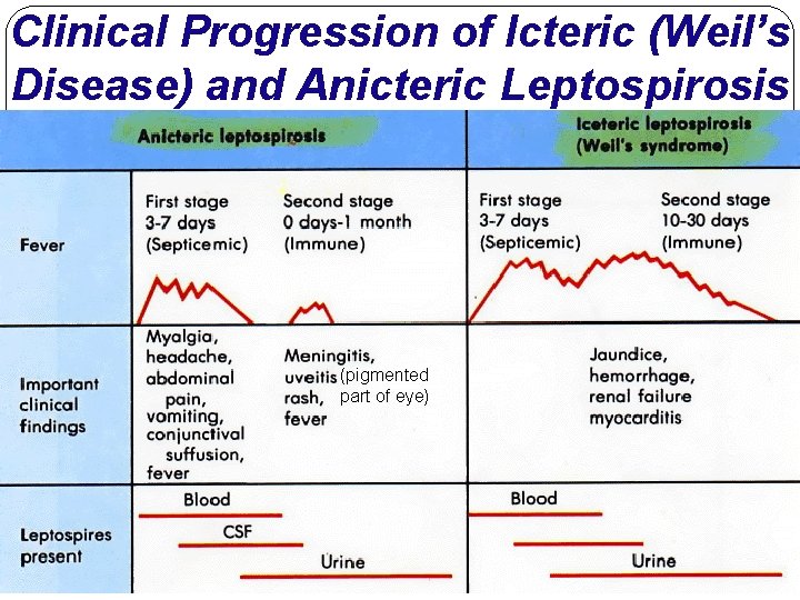 Clinical Progression of Icteric (Weil’s Disease) and Anicteric Leptospirosis (pigmented part of eye) 