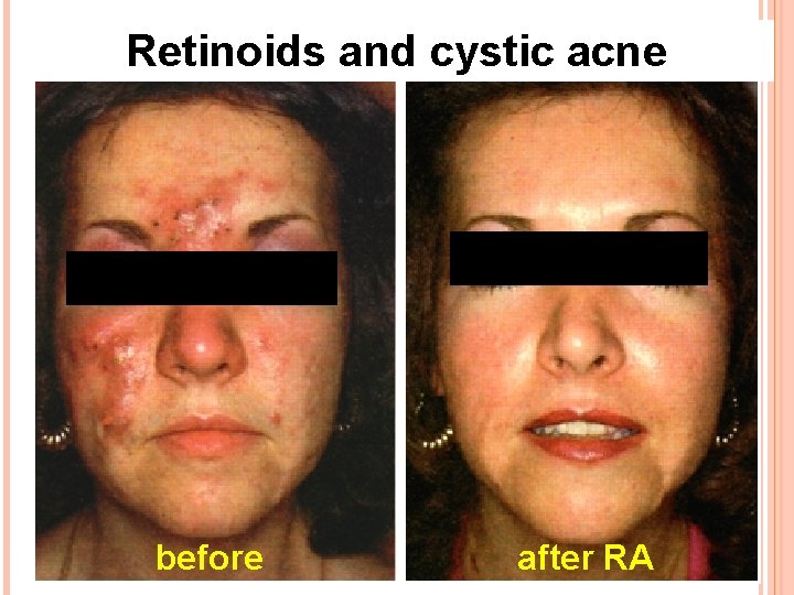 Retinoids and cystic acne before after RA 