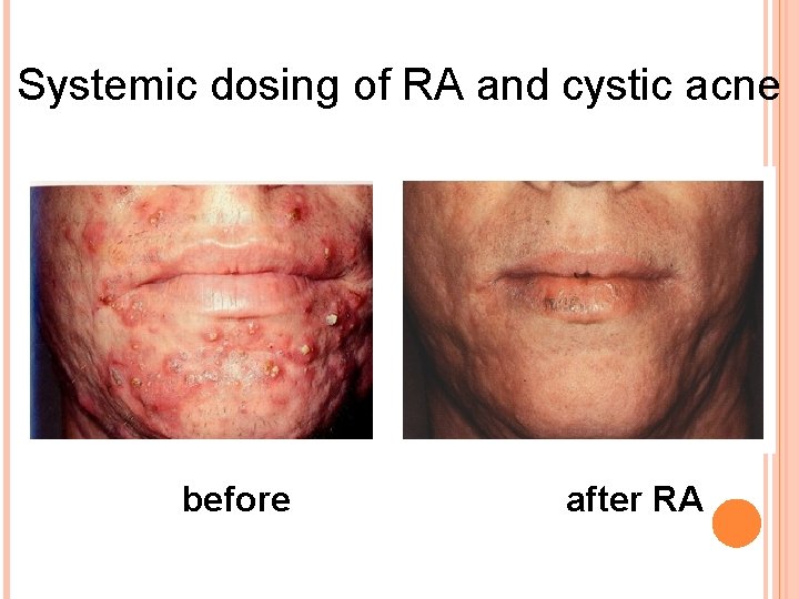 Systemic dosing of RA and cystic acne before after RA 