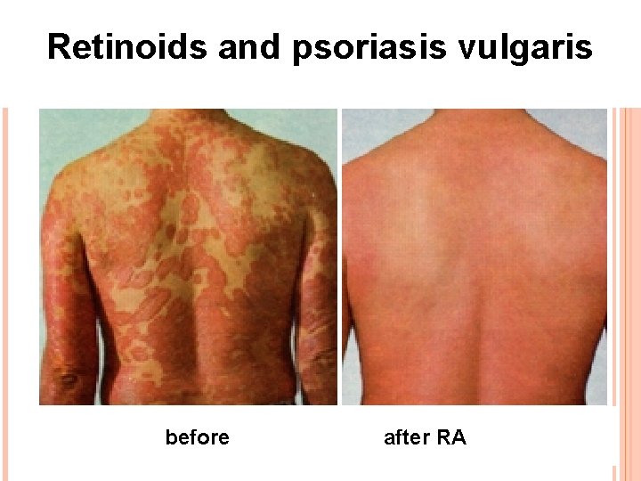 Retinoids and psoriasis vulgaris before after RA 