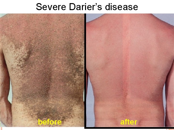 Severe Darier’s disease before after 