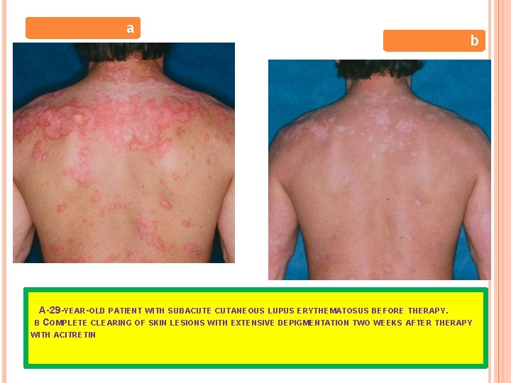 a b A-29 -YEAR-OLD PATIENT WITH SUBACUTE CUTANEOUS LUPUS ERYTHEMATOSUS BEFORE THERAPY. B COMPLETE