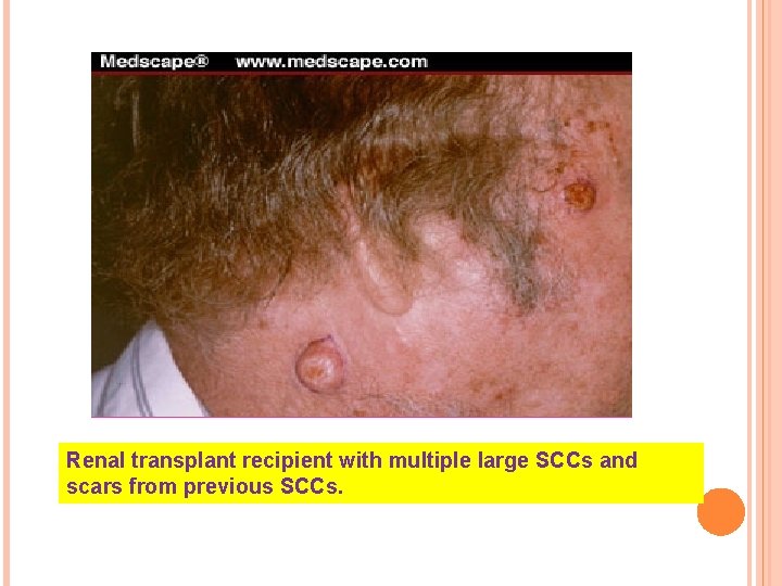 Renal transplant recipient with multiple large SCCs and scars from previous SCCs. 