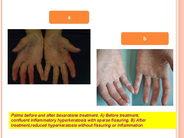 a b Palms before and after bexarotene treatment. A) Before treatment, confluent inflammatory hyperkeratosis