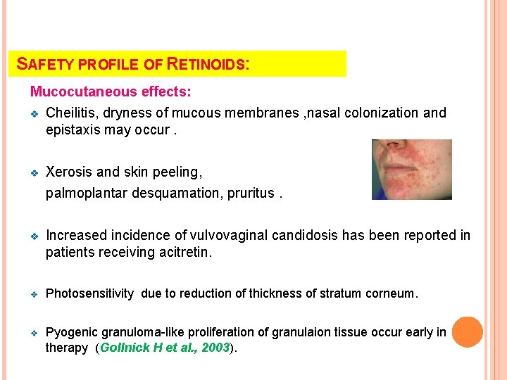 SAFETY PROFILE OF RETINOIDS: Mucocutaneous effects: v Cheilitis, dryness of mucous membranes , nasal