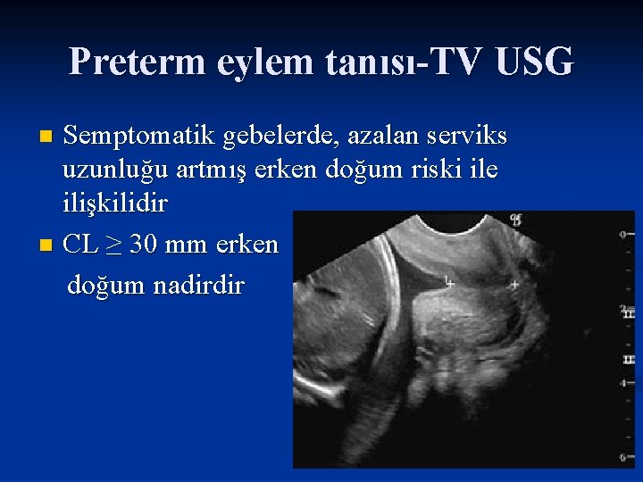 Preterm eylem tanısı-TV USG Semptomatik gebelerde, azalan serviks uzunluğu artmış erken doğum riski ile