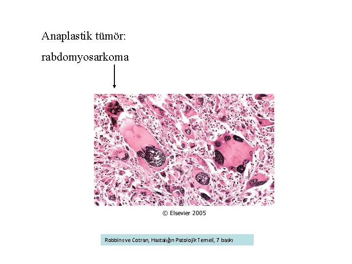 Anaplastik tümör: rabdomyosarkoma Robbins ve Cotran, Hastalığın Patolojik Temeli, 7 baskı 