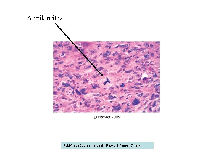 Atipik mitoz Robbins ve Cotran, Hastalığın Patolojik Temeli, 7 baskı 