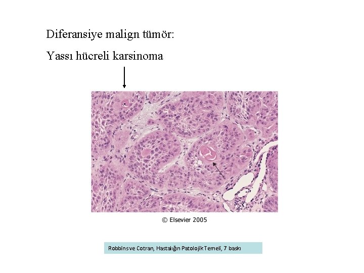 Diferansiye malign tümör: Yassı hücreli karsinoma Robbins ve Cotran, Hastalığın Patolojik Temeli, 7 baskı