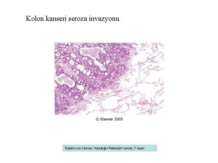 Kolon kanseri seroza invazyonu Robbins ve Cotran, Hastalığın Patolojik Temeli, 7 baskı 