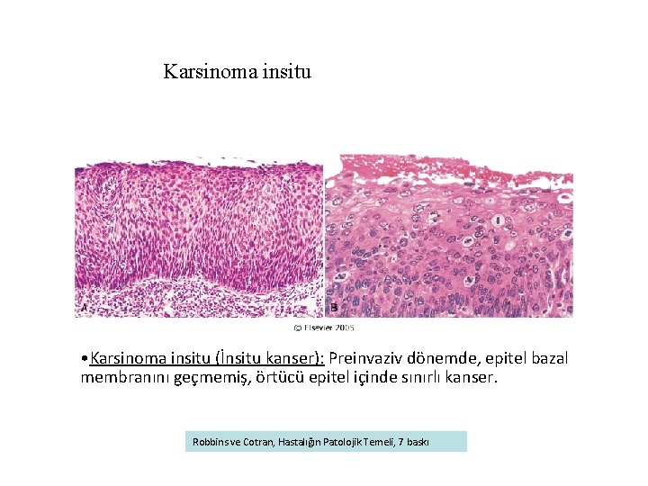 Karsinoma insitu • Karsinoma insitu (İnsitu kanser): Preinvaziv dönemde, epitel bazal membranını geçmemiş, örtücü