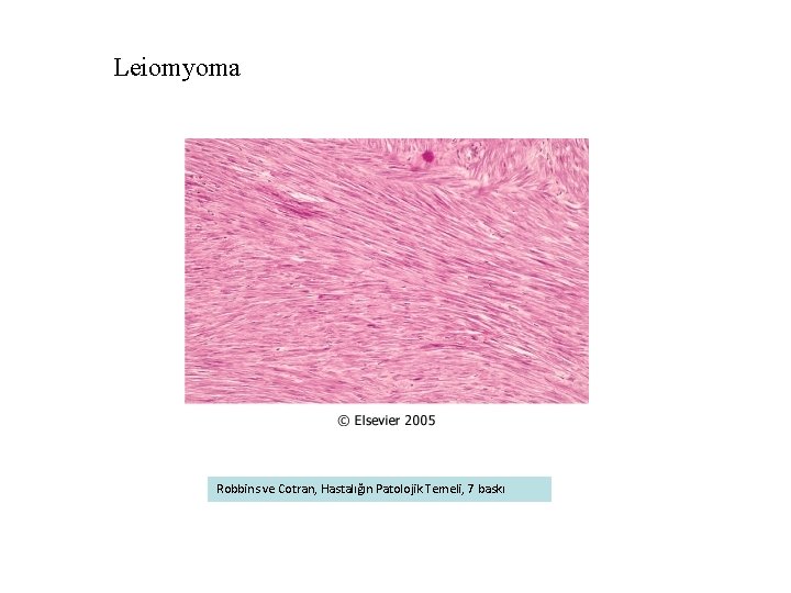 Leiomyoma Robbins ve Cotran, Hastalığın Patolojik Temeli, 7 baskı 