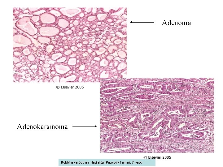 Adenoma Adenokarsinoma Robbins ve Cotran, Hastalığın Patolojik Temeli, 7 baskı 