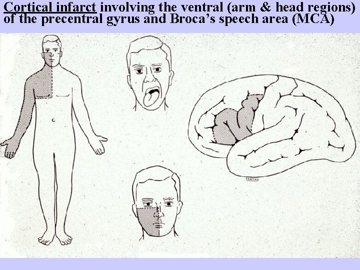 Cortical infarct involving the ventral (arm & head regions) of the precentral gyrus and