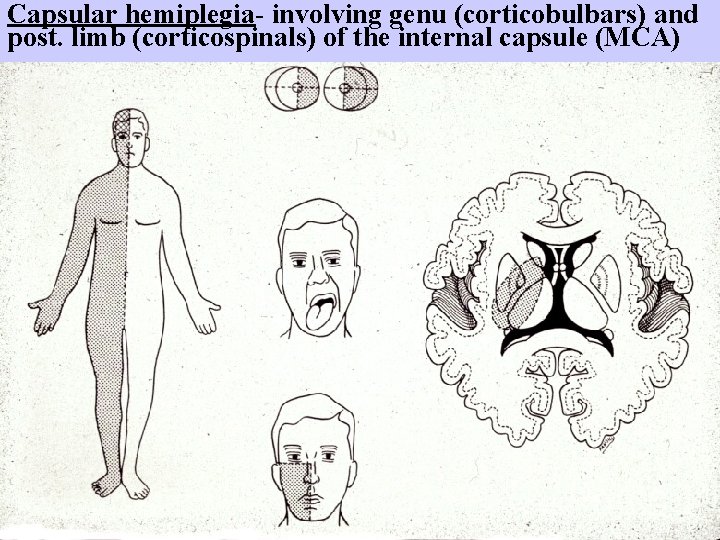 Capsular hemiplegia- involving genu (corticobulbars) and post. limb (corticospinals) of the internal capsule (MCA)