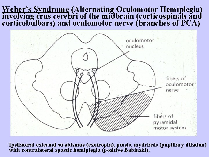 Weber’s Syndrome (Alternating Oculomotor Hemiplegia) involving crus cerebri of the midbrain (corticospinals and corticobulbars)