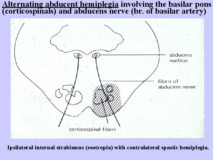 Alternating abducent hemiplegia involving the basilar pons (corticospinals) and abducens nerve (br. of basilar