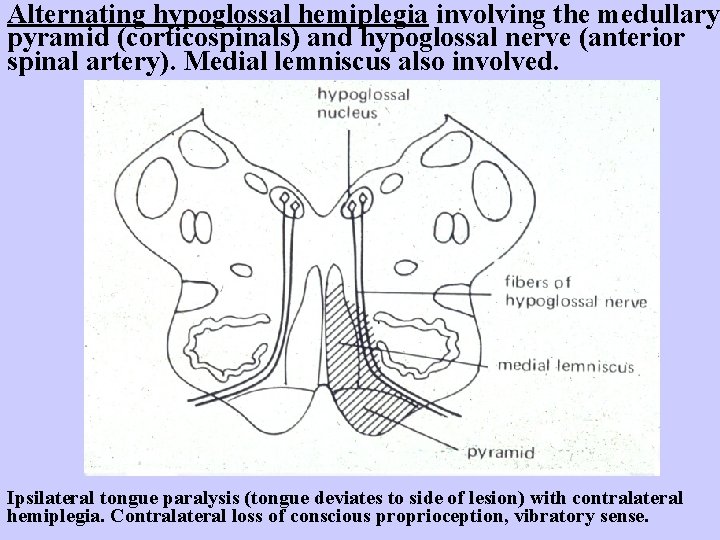 Alternating hypoglossal hemiplegia involving the medullary pyramid (corticospinals) and hypoglossal nerve (anterior spinal artery).