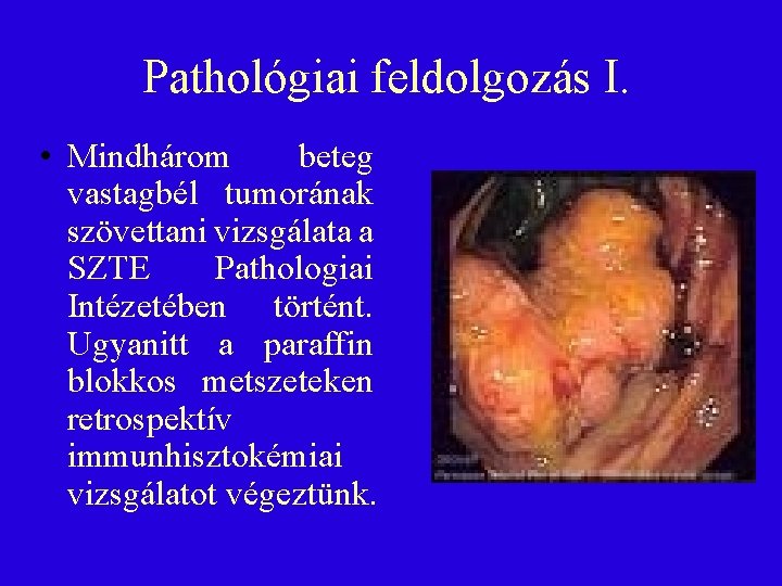 Pathológiai feldolgozás I. • Mindhárom beteg vastagbél tumorának szövettani vizsgálata a SZTE Pathologiai Intézetében