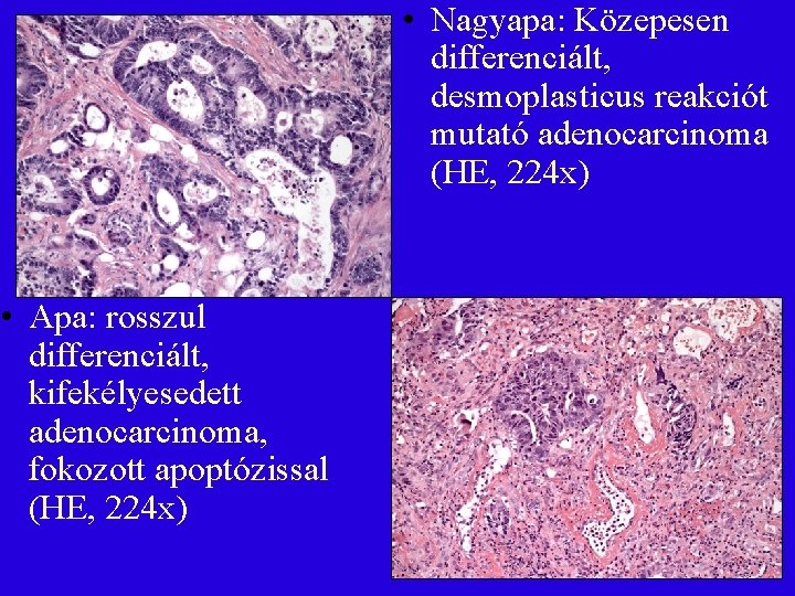  • Apa: rosszul differenciált, kifekélyesedett adenocarcinoma, fokozott apoptózissal (HE, 224 x) • Nagyapa: