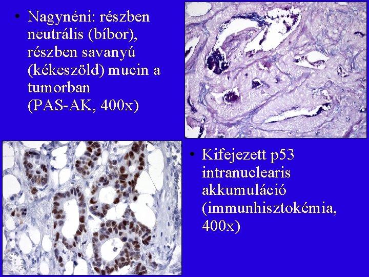  • Nagynéni: részben neutrális (bíbor), részben savanyú (kékeszöld) mucin a tumorban (PAS-AK, 400