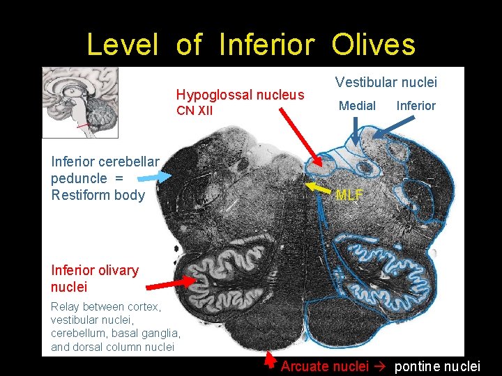 Level of Inferior Olives Hypoglossal nucleus CN XII Inferior cerebellar peduncle = Restiform body