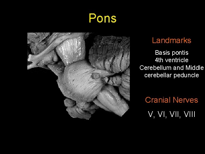 Pons Landmarks Basis pontis 4 th ventricle Cerebellum and Middle cerebellar peduncle Cranial Nerves