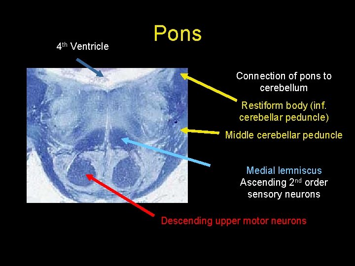 4 th Ventricle Pons Connection of pons to cerebellum Restiform body (inf. cerebellar peduncle)