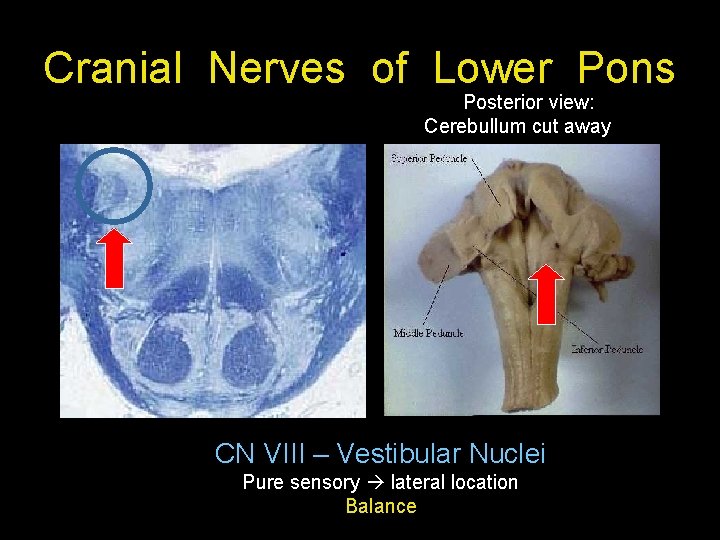 Cranial Nerves of Lower Pons Posterior view: Cerebullum cut away CN VIII – Vestibular