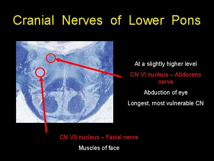 Cranial Nerves of Lower Pons At a slightly higher level CN VI nucleus –