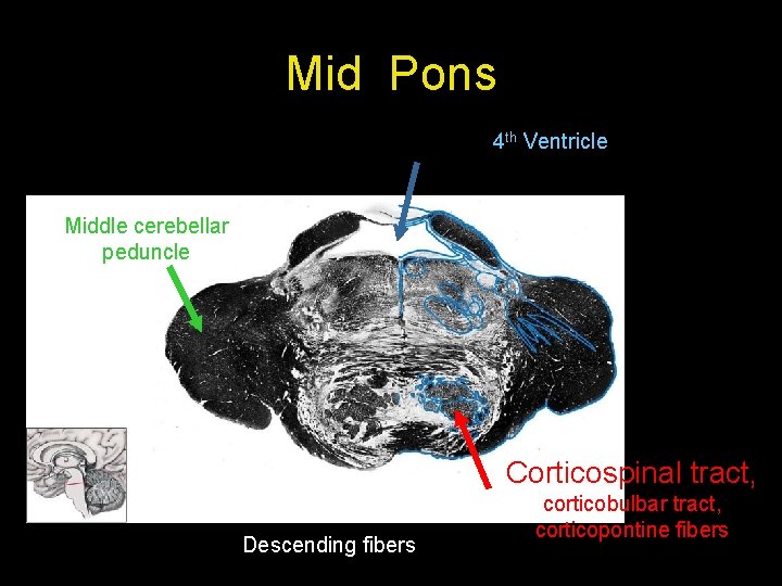 Mid Pons 4 th Ventricle Middle cerebellar peduncle Corticospinal tract, Descending fibers corticobulbar tract,